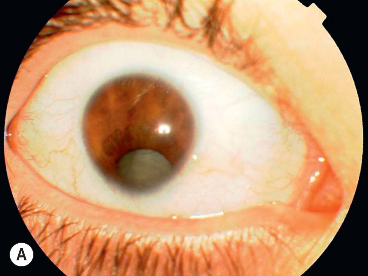 Fig. 51.7, Bilateral coloboma associated with microphthalmos, nystagmus, and cataract. Intercalary membrane simulating retinal detachment on B-scan ultrasonography (not shown).