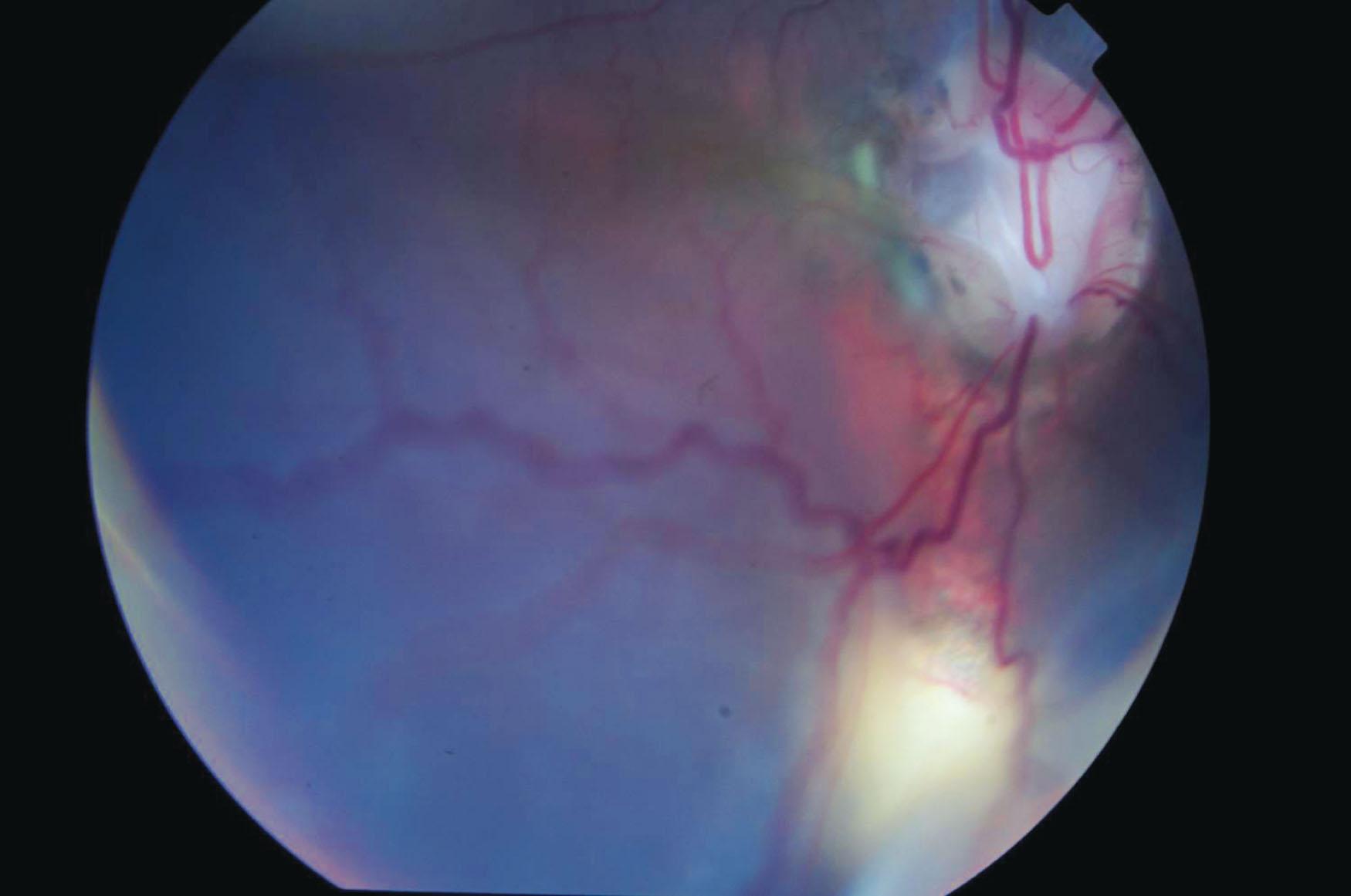 Fig. 51.8, Rhegmatogenous retinal detachment complicating coloboma in a 9-year-old boy. Retinal breaks may be difficult to identify preoperatively, but visualization of schlieren (proteinaceous subretinal fluid) during vitrectomy can assist localization.