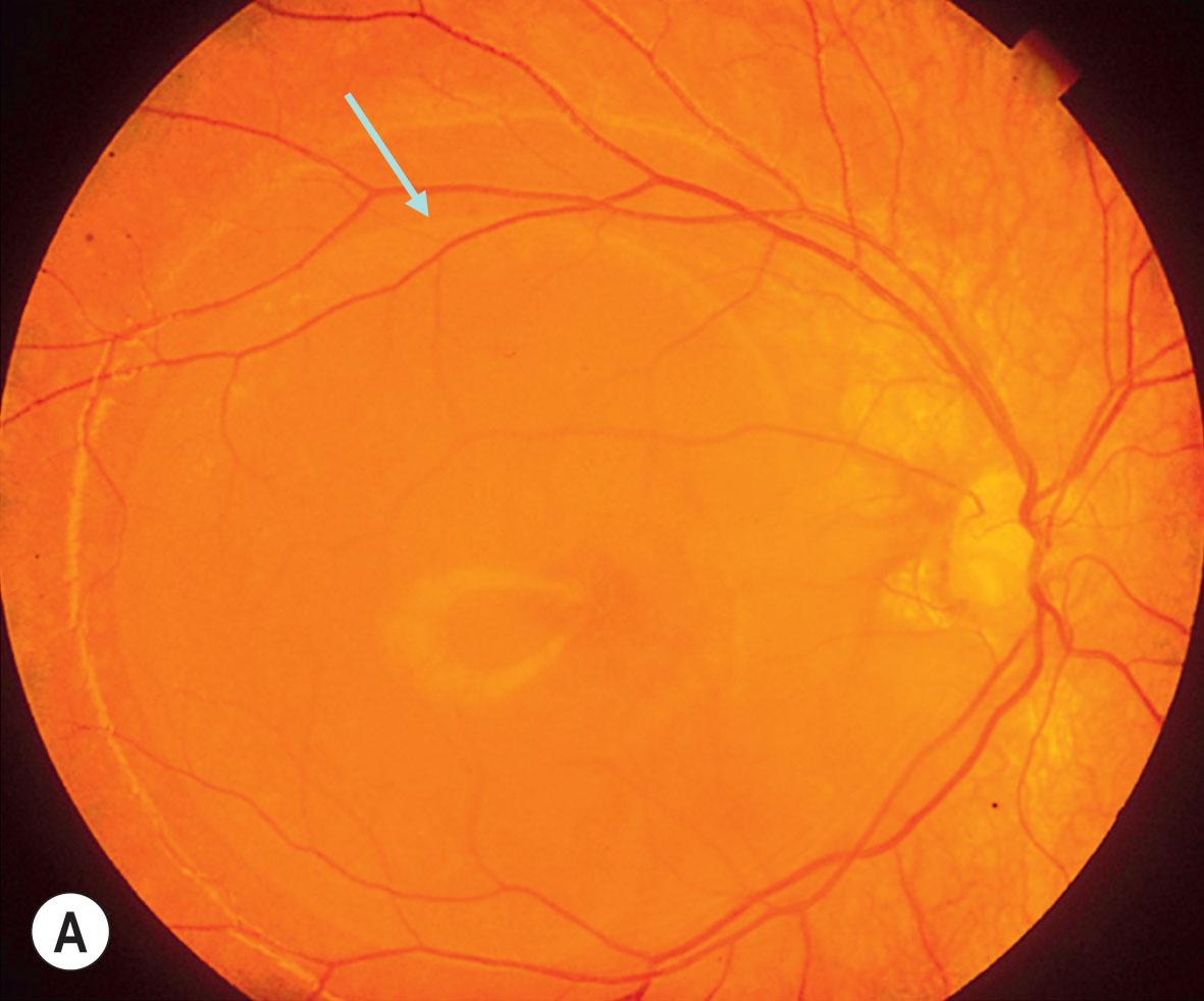 Fig. 51.9, (A–B) Two examples of optic disc colobomas associated with macular detachment (arrows). (C–D) Child (optic disc pit with serous macular detachment [arrows]) and parent (choroidal coloboma [arrowhead]), respectively, illustrating in-herited etiology in some cases.