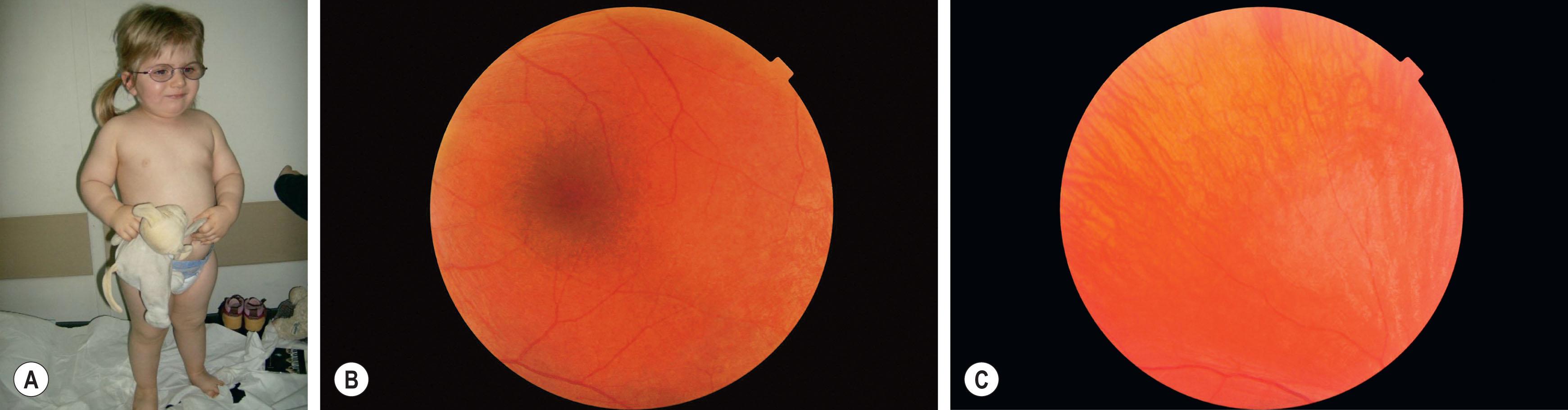 Fig. 46.4, Alström syndrome. (A) This 26-month-old girl was noted to be photophobic and overweight. She has pathogenic variants in the ALS gene. (B) Fundus photograph of the patient's macular region showing marked irregularity of the macula. Electroretinogram shows severe photopic reduction and a lesser degree of scotopic impairment. (C) Photograph of the peripheral retina; it is thinned with patchy pigmentation.