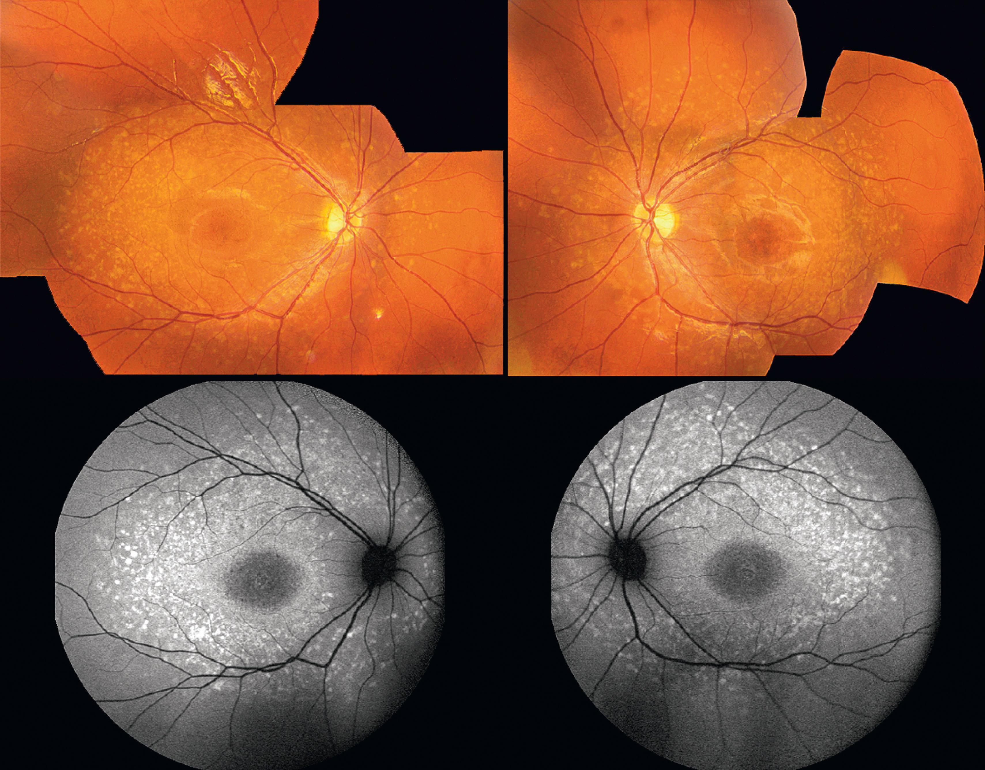 Fig. 49.1, Stargardt disease. Fundus photograph of the left and right eyes of a 9-year-old individual with Stargardt disease (top row). Fundus autofluoresence imaging (bottom row) revealed hyperautofluorescent lesions corresponding to the flecks and abnormal autofluorescence at the foveal region.