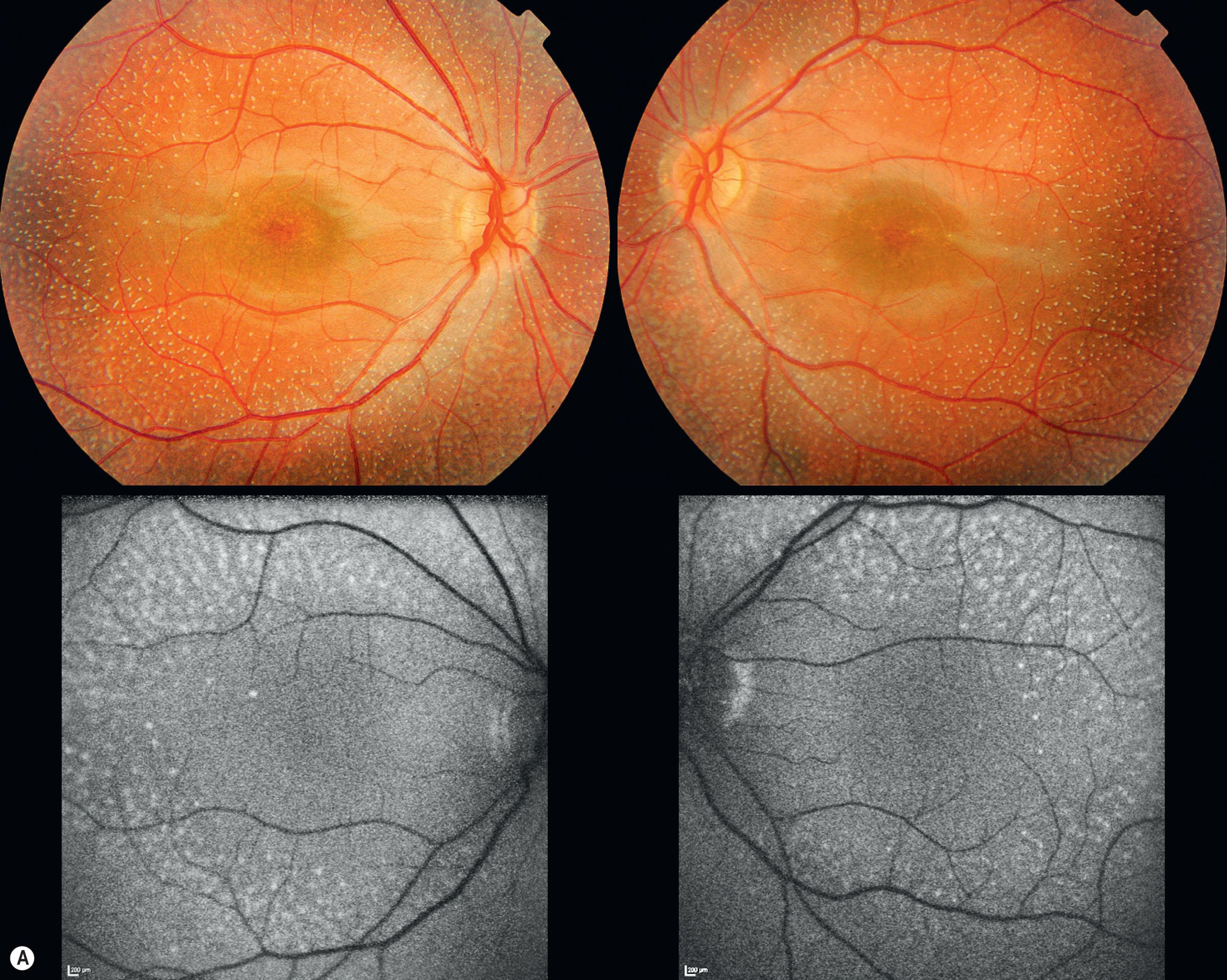Fig. 49.3, Fundus albipunctatus. (A) Fundus photograph of the left and right eyes of an 18-year-old RDH5 mutation-positive individual (top row). Fundus autofluorescence imaging (bottom row) revealed hyperautofluorescent lesions; these are unlikely to represent lipofuscin accumulation. (B) Fundus photographs of the left and right eyes of a 10-year-old, RDH5 mutation-positive individual (top row). Optical coherence tomography (horizontal, centered on the fovea, linear scan of the left eye; bottom row) revealed hyper-reflective lesions extending from the retinal pigment epithelium to the outer nuclear layer.