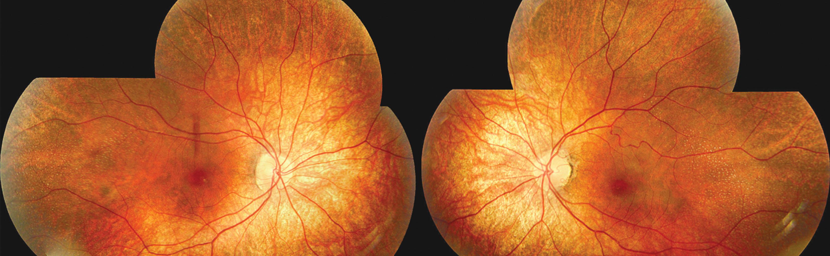 Fig. 49.4, Retinitis punctata albescens. Fundus photograph of the left and right eyes of a 15-year-old RLBP1 mutation-positive individual.