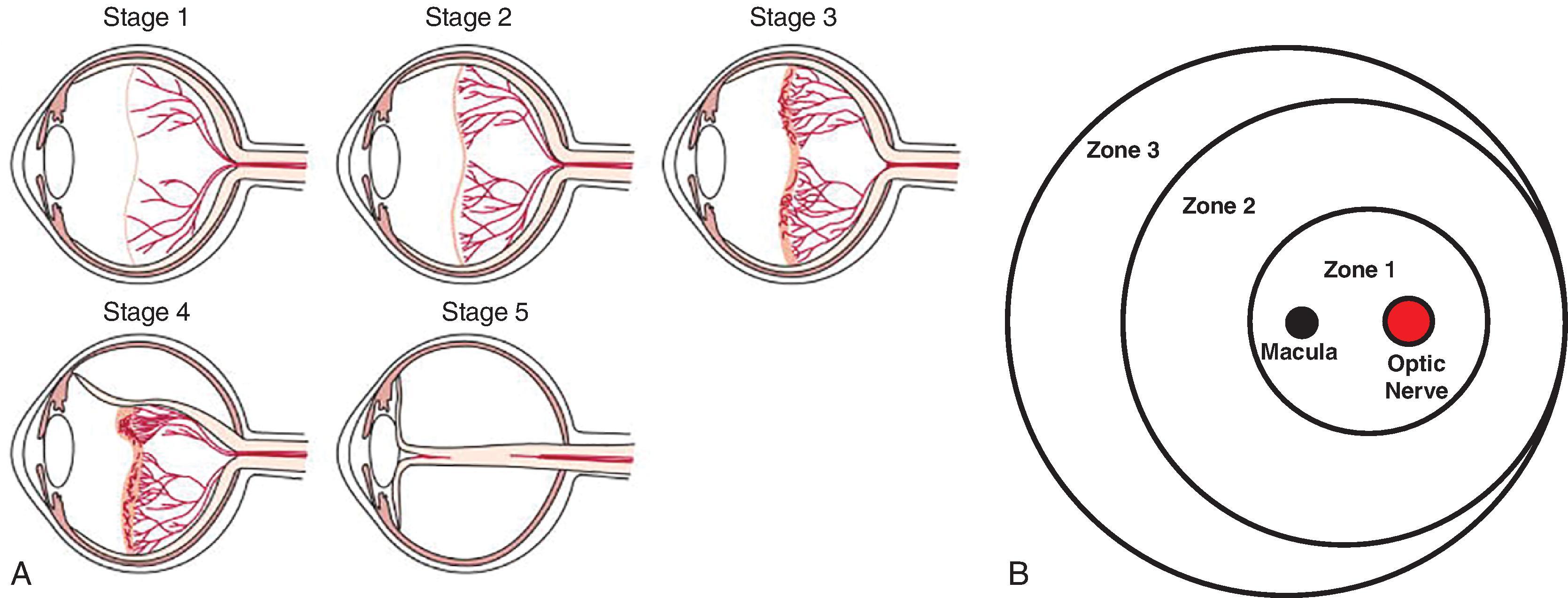 Fig. 62.1, Zones and Stages of Retinopathy of Prematurity (ROP) .