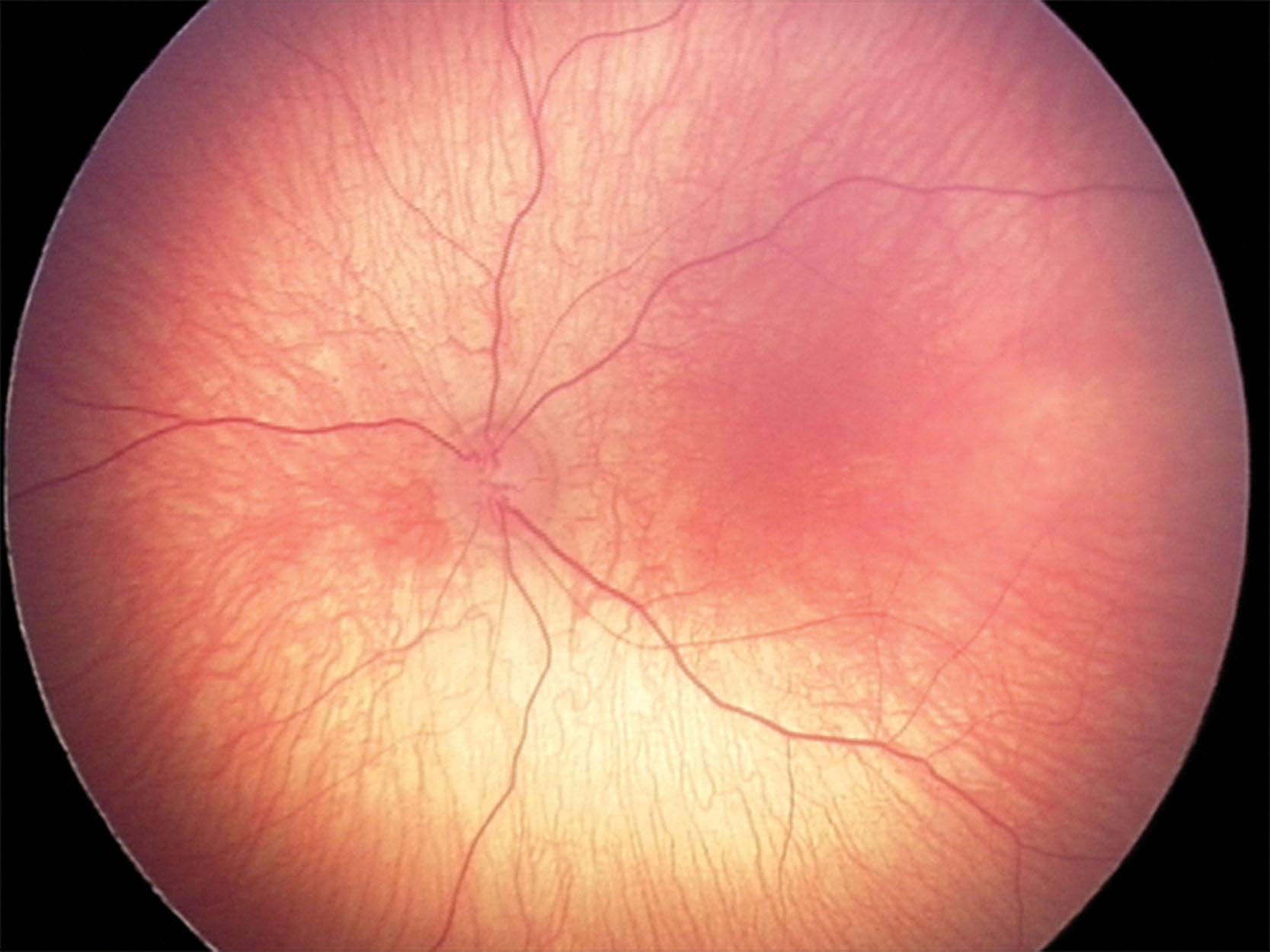 Fig. 43.1, Normal retinal vessels in a preterm baby without retinopathy of prematurity.