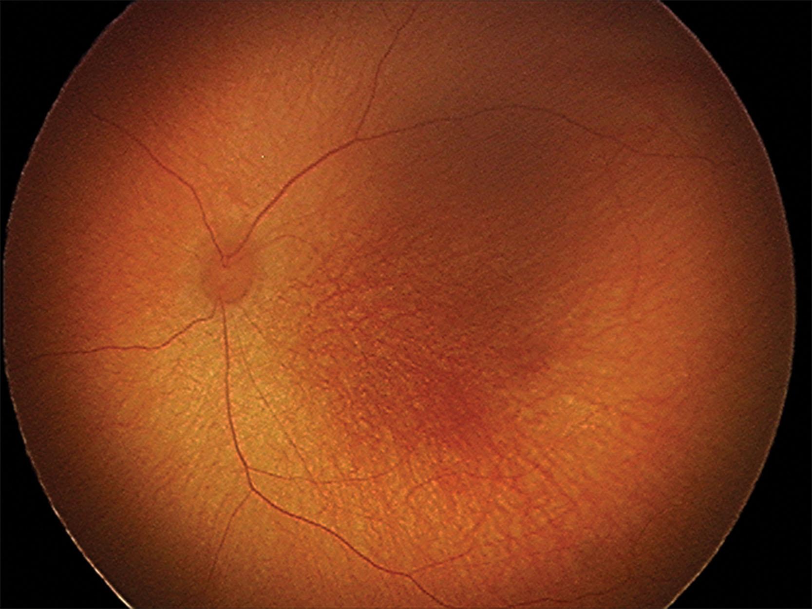 Fig. 43.2, Immature retinal vessels in an extremely preterm infant. The retinal vessels are thin and straight. There was no retinopathy of prematurity on this clinical examination, but the infant requires close follow-up.