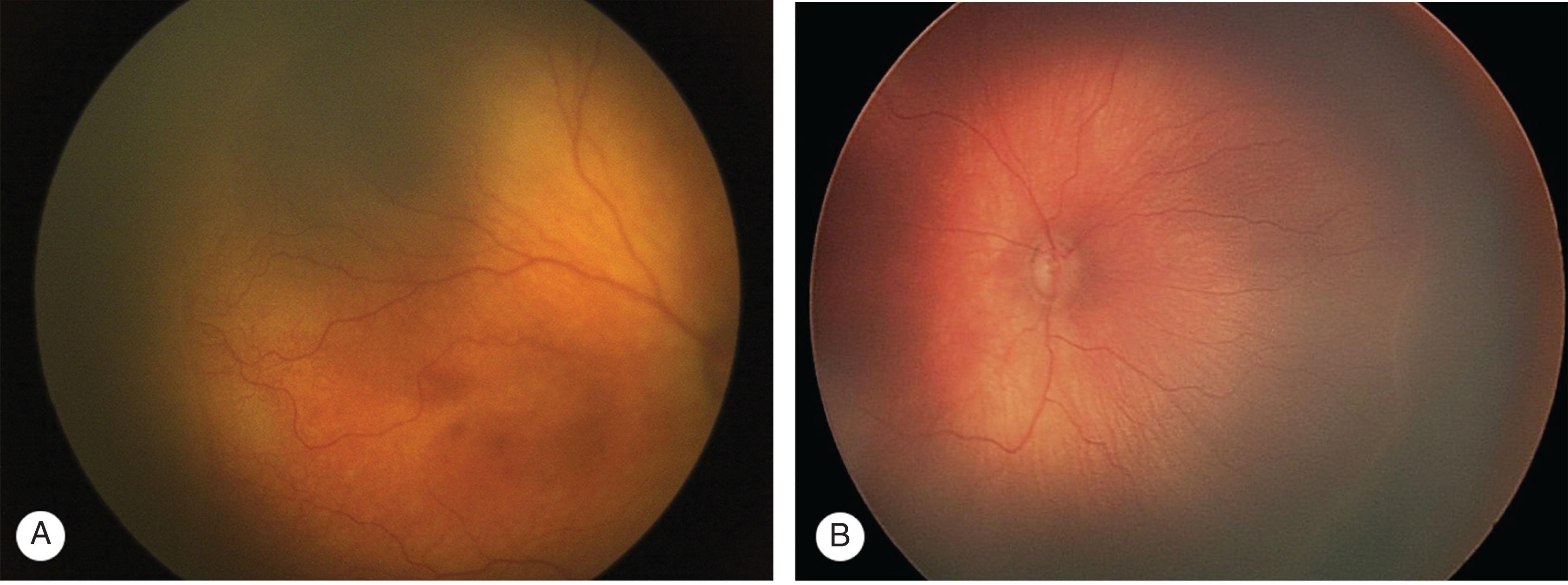 Fig. 43.3, Stage 1 retinopathy of prematurity. Two examples of thin demarcation lines in the temporal retina (A) and the nasal retina (B) separating vascularized from avascular retinal regions. Stage 1 may be difficult to appreciate clinically despite being apparent with bedside imaging.