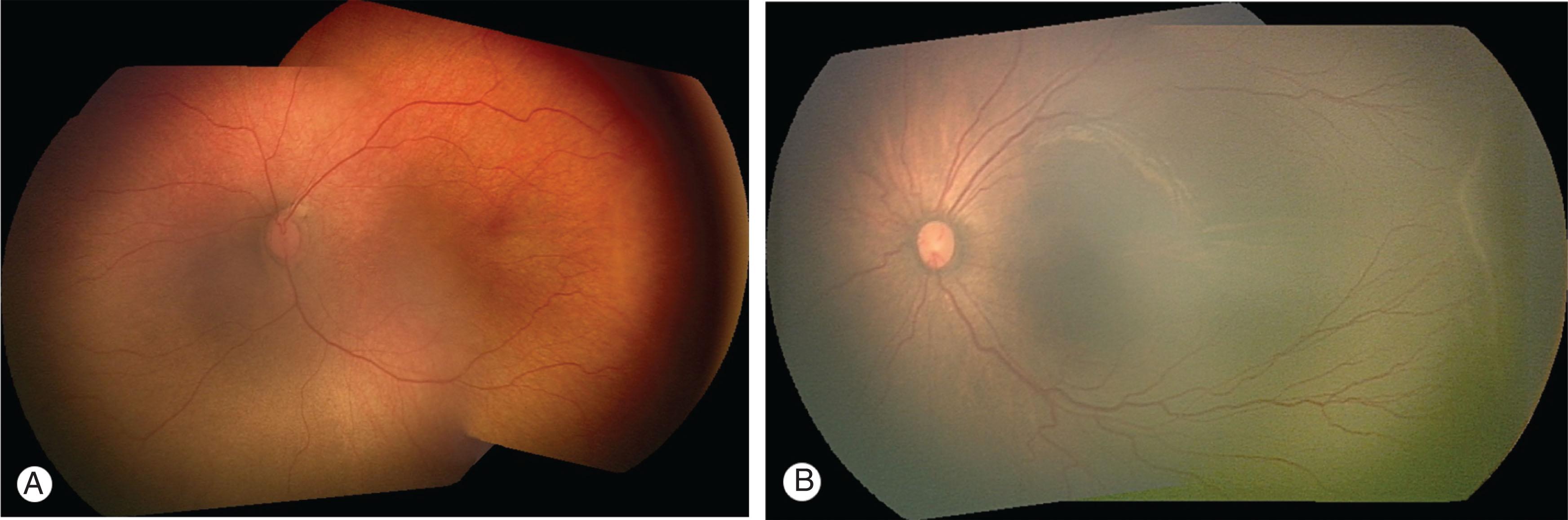 Fig. 43.4, Mild retinopathy of prematurity. Differentiating stage 1 (A) and stage 2 (B) can be difficult clinically. Note the subtle demarcation line temporally in stage 1 compared to the thicker line with an anterior shadow, indicating ridge elevation, in stage 2.