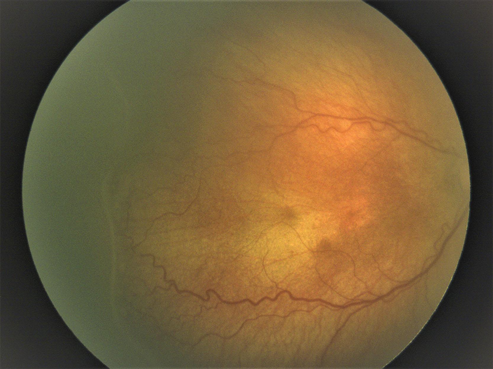 Fig. 43.5, Stage 2 retinopathy of prematurity with pre-plus disease. Thick line present in the temporal retina. The small tufts of neovascular tissue lying on the surface of the retina are referred to as “popcorn” and can be seen posterior to ridges; these are usually benign. Note the increased vessel tortuosity compared to ( Figs. 43.3 and 43.4 ) but the mild appearance compared to Fig. 43.9 .