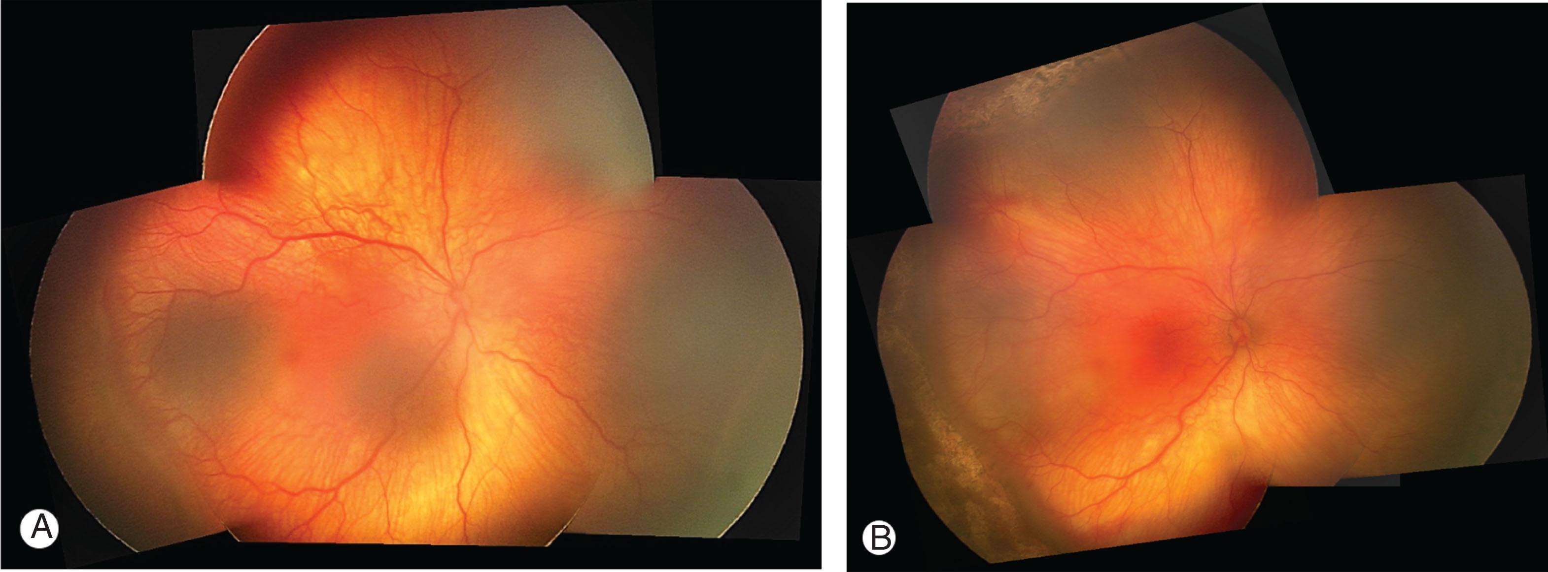 Fig. 43.6, Type 1 retinopathy of prematurity. (A) Stage 3 temporally with neovascularization and hemorrhages along the elevated ridge. Note the venous dilation and arteriolar tortuosity (plus disease) with a vascular branching pattern. Stage 2 is present in the nasal retina. (B) The same eye after laser photocoagulation to the avascular periphery.