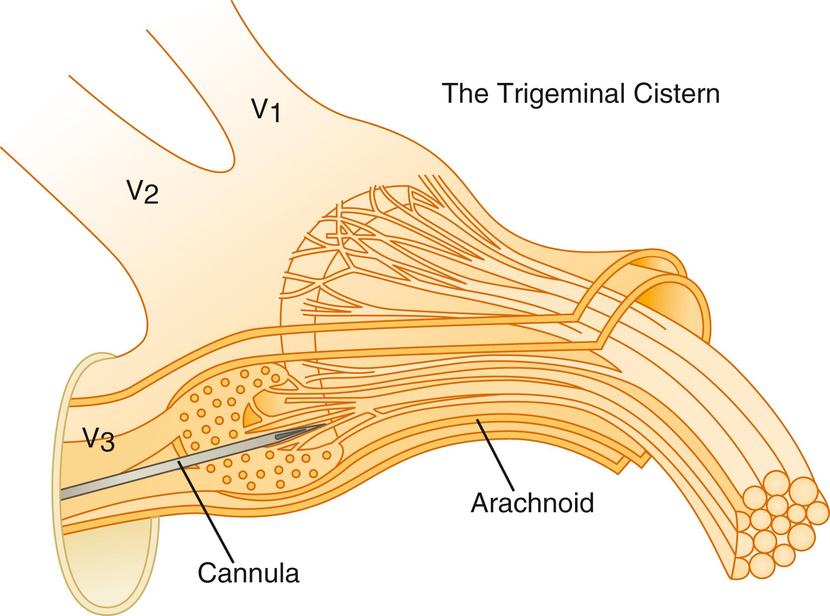 FIGURE 114.1, Schematic picture illustrating the contents of the Meckel cave: the Gasserian ganglion, the retroganglionic root fibers in the cerebrospinal fluid–filled cistern, and the meningeal coverings. A needle is penetrating the ganglion, entering the cistern.