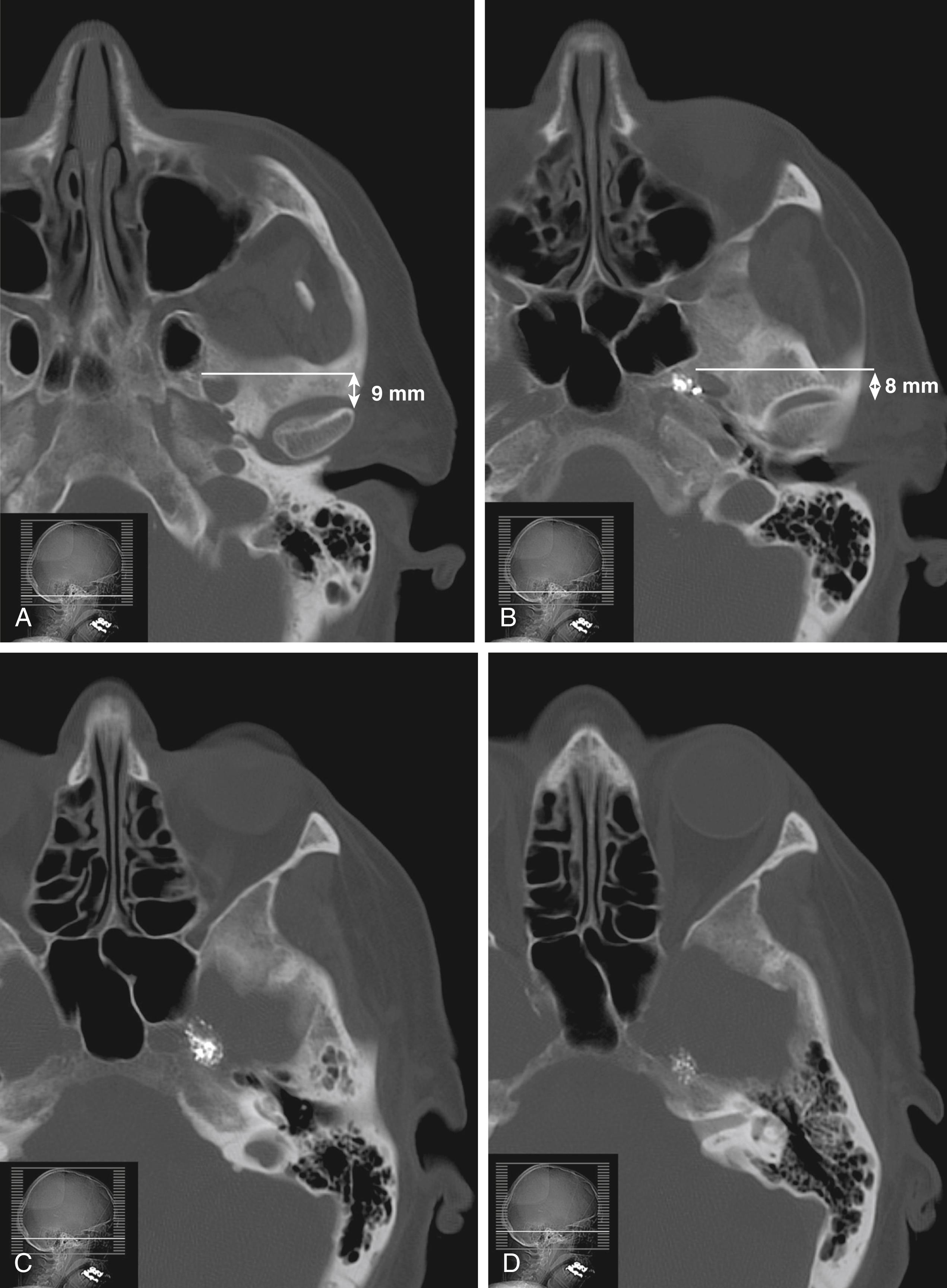 FIGURE 114.2, Consecutive axial computed tomography scan images of a patient with intracisternal tantalum dust.