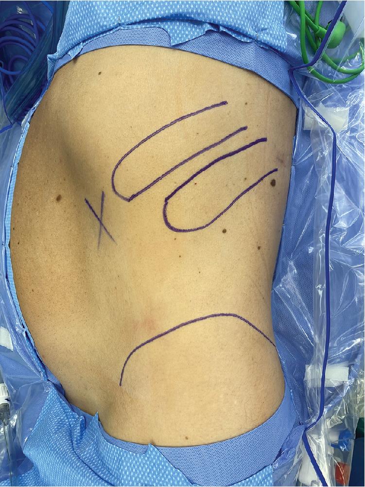 Fig. 20.2, Surgical Marking of the 11th and 12th Ribs and Iliac Crest.