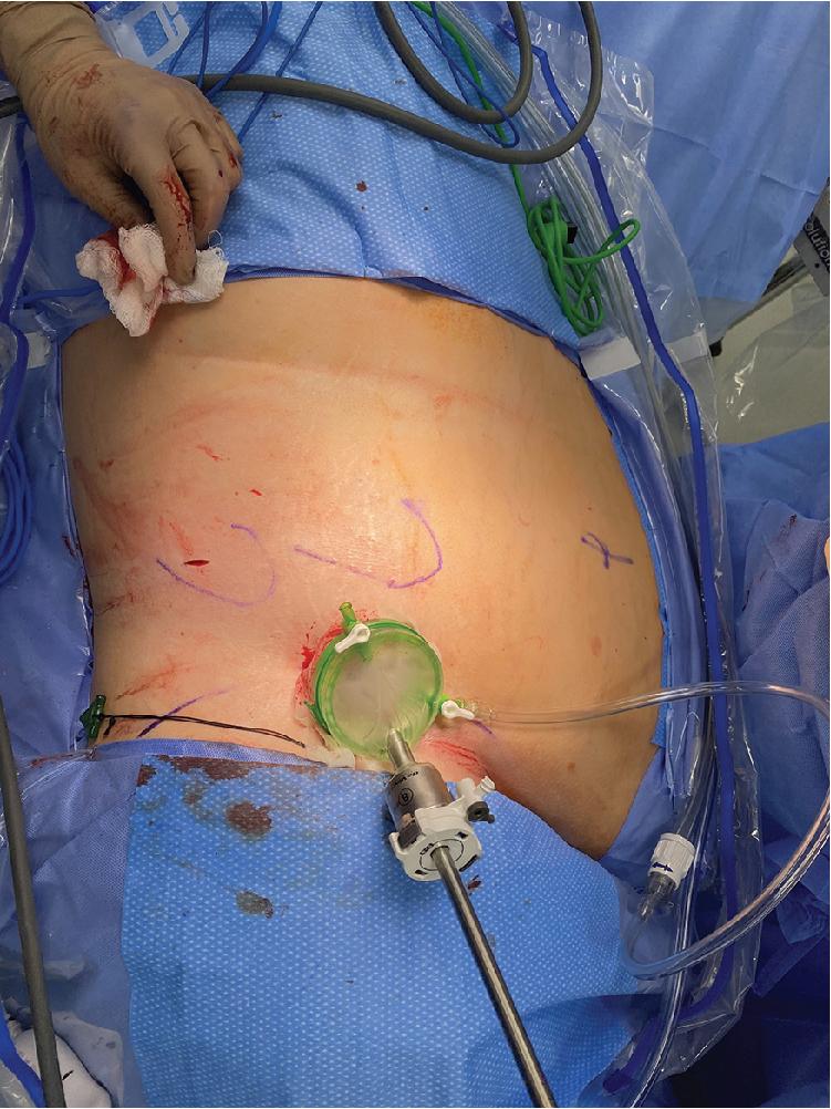 Fig. 20.3, Gelpoint Mini Placement in the Obese Patient.