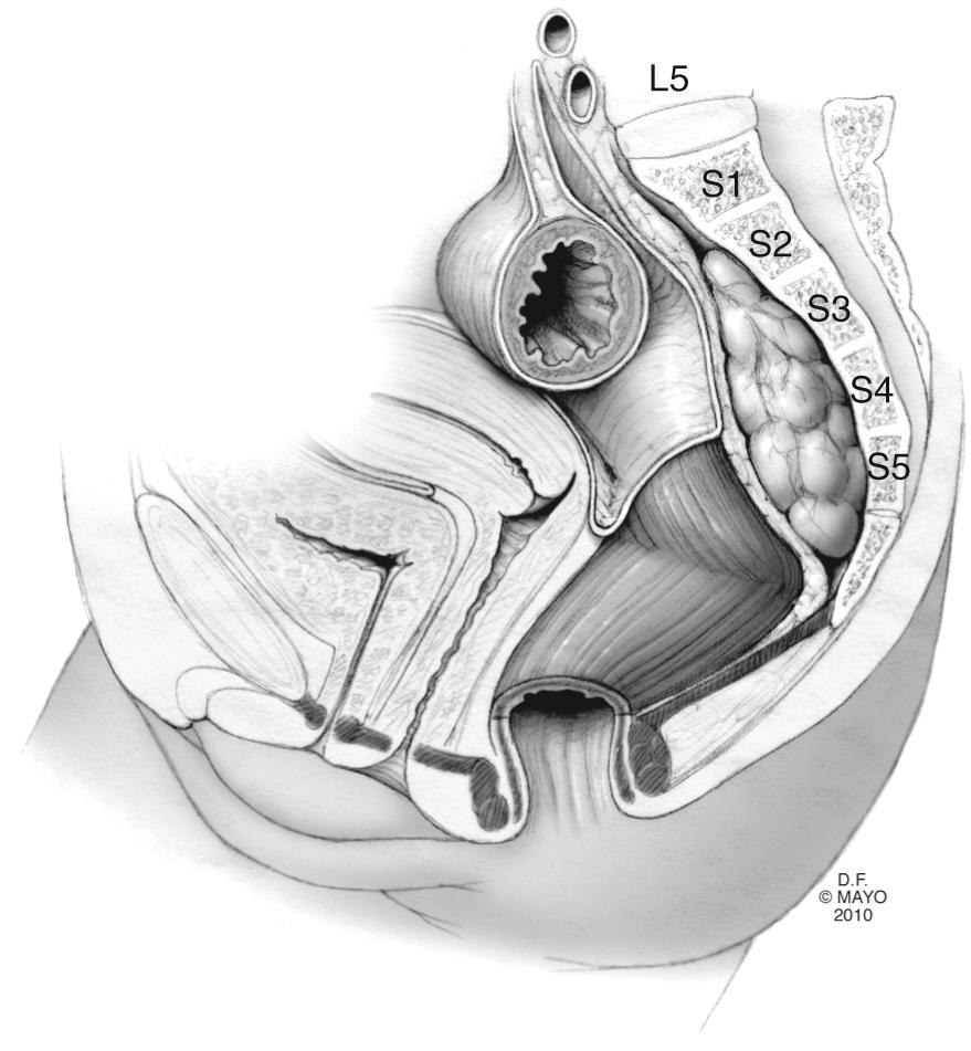 FIGURE 174.1, Retrorectal mass displacing pelvic organs.