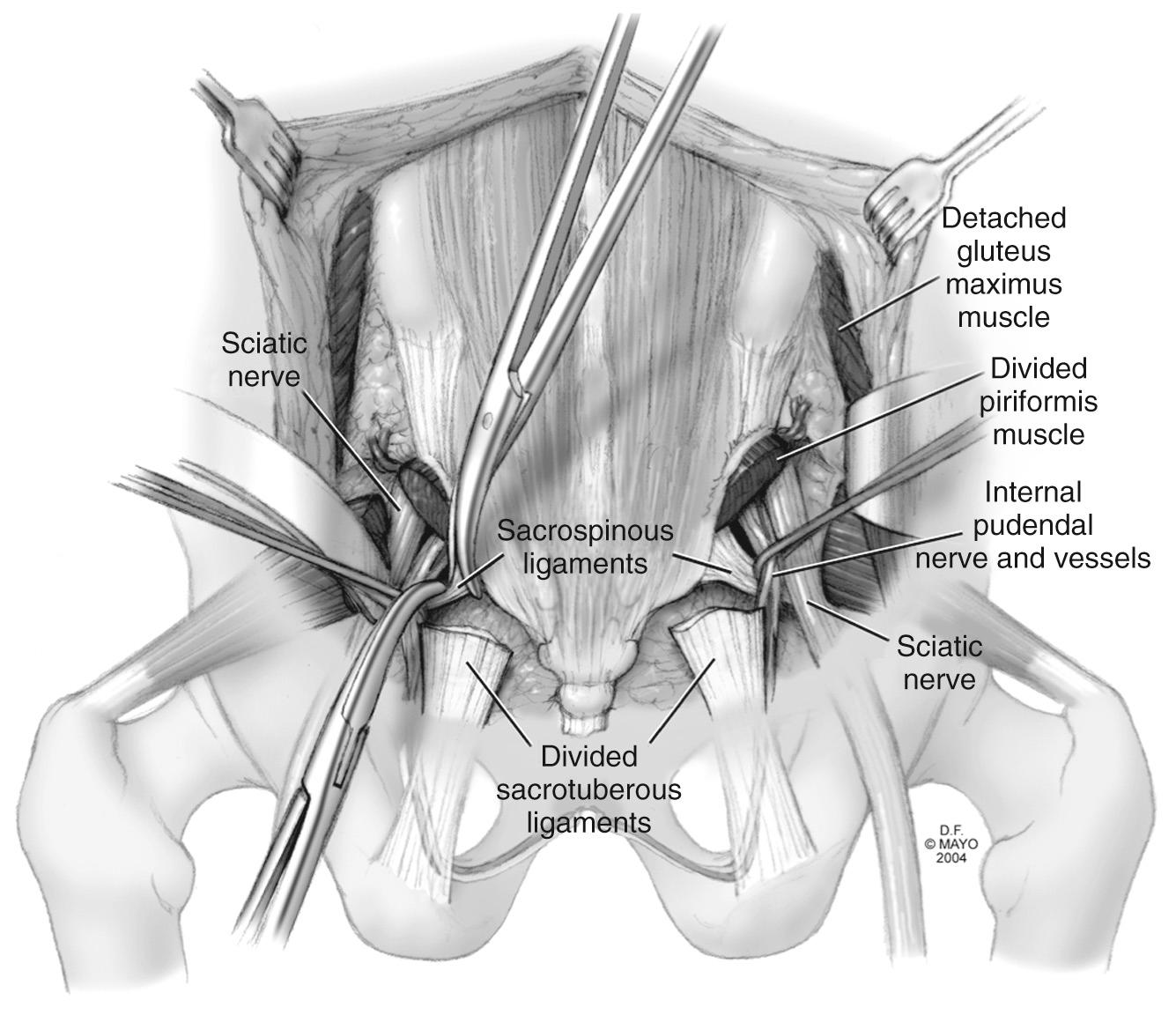 FIGURE 174.3, Anatomy of posterior sacrum: sacrotuberous and sacrospinous ligaments.