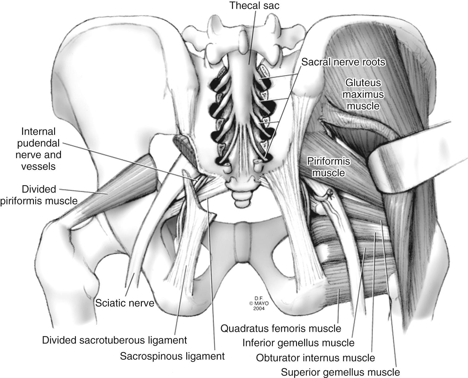 FIGURE 174.4, Anatomy of posterior sacrum: piriformis muscle and sciatic and pudendal nerves.