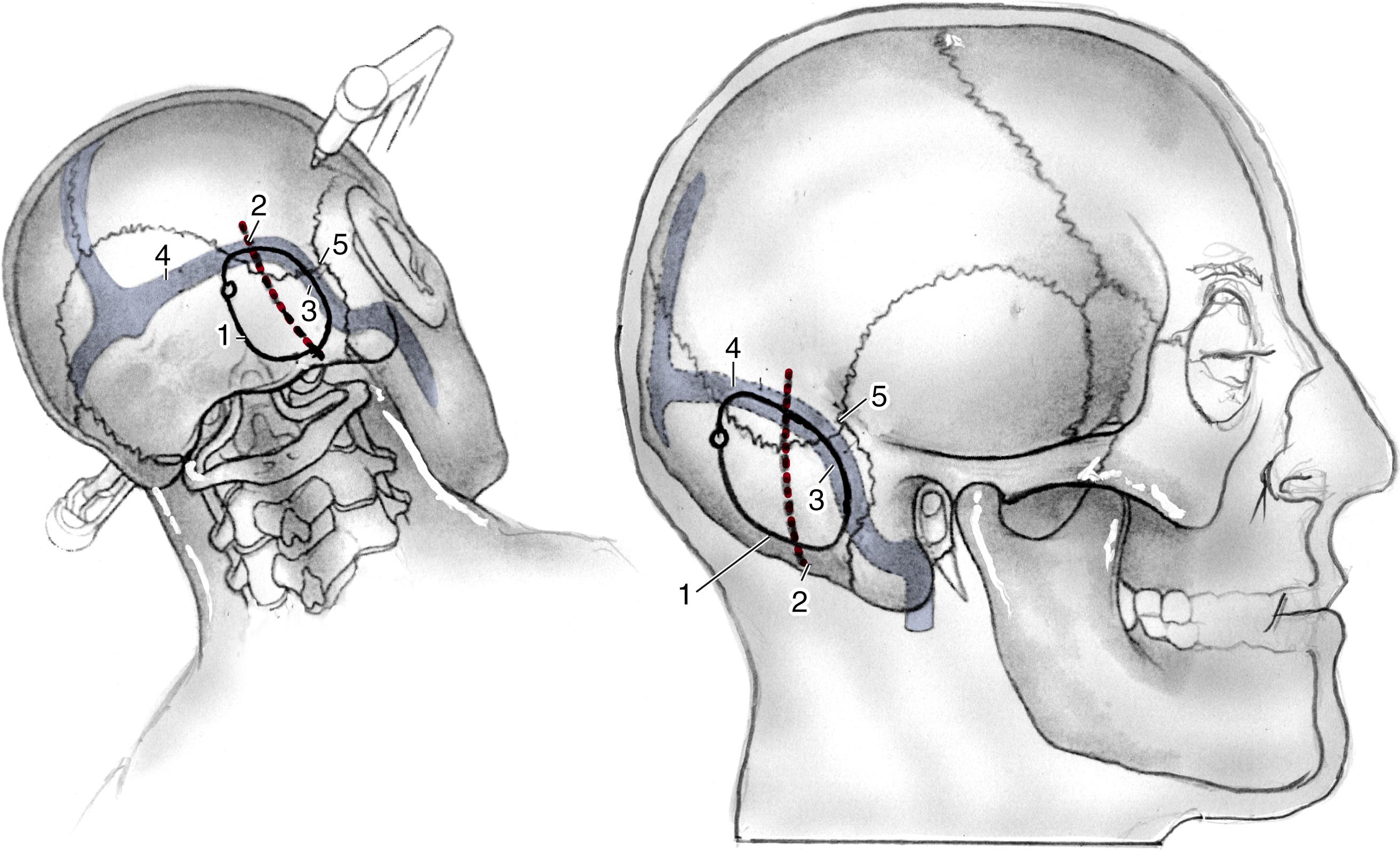 Fig. 45.1, The incision used in the retrosigmoid approach is located approximately 6 cm behind the postauricular sulcus. After craniectomy and retraction of the cerebellum, the tumor becomes visible within the cerebellopontine angle. The anterior edge of the craniotomy is placed immediately behind the sigmoid sinus and just inferiorly to the lower margin of the transverse sinus. 1 , Craniotomy outline; 2 , skin incision; 3 , sigmoid sinus; 4 , transverse sinus; 5 , asterion.