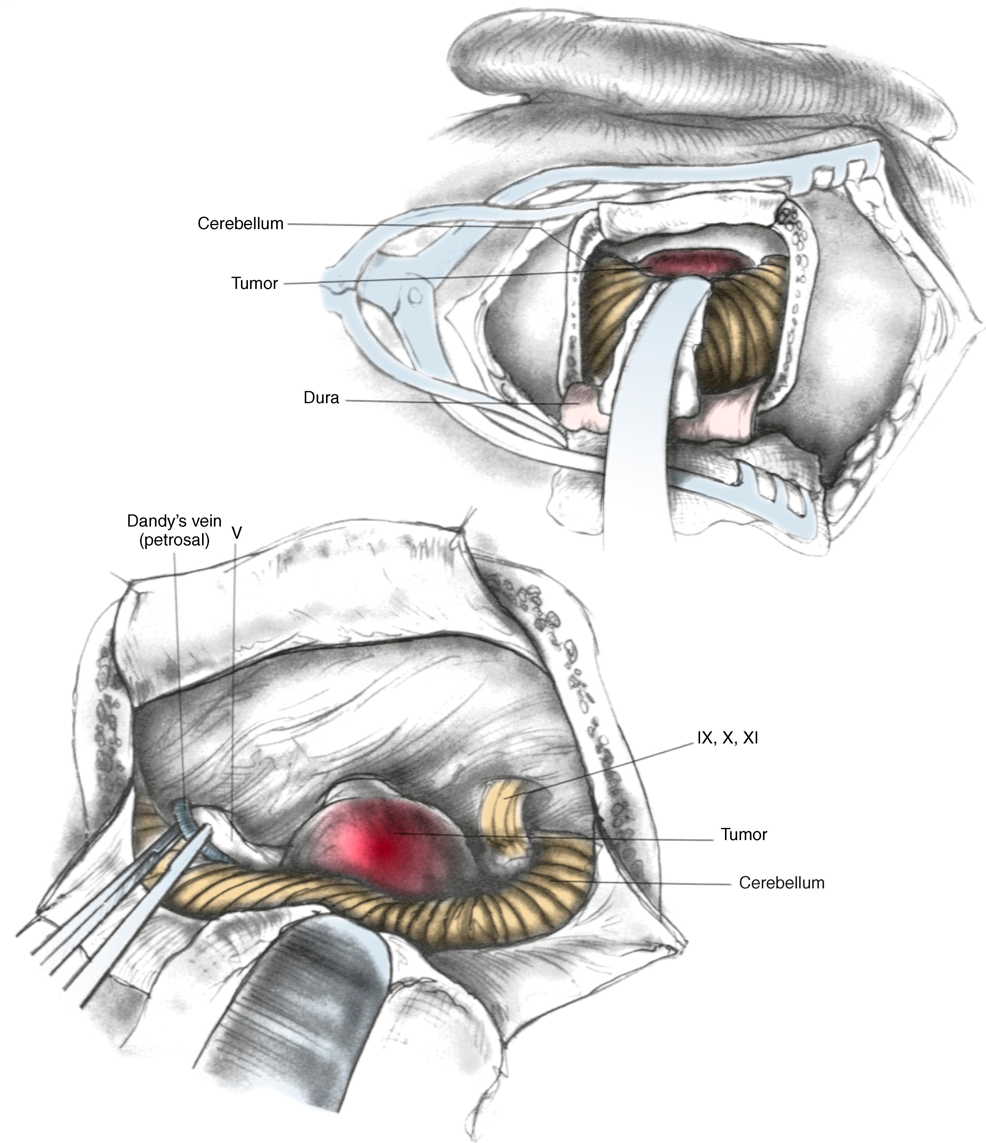 Fig. 45.2, Operative view of the cerebellopontine angle as seen through the retrosigmoid approach. Superiorly is the trigeminal nerve (CN V) and petrosal vein. Inferiorly are the lower cranial nerves (IX, X, and XI). In the midsection of the exposure, a medium-sized vestibular schwannoma is seen in relation to the facial and audiovestibular nerves.