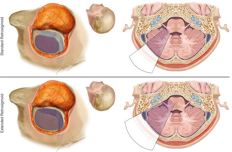 Figure 21.1, Comparison between the standard ( upper ) and extended ( lower ) retrosigmoid craniotomies in the surgical position ( left ) and in an axial cut ( right ).