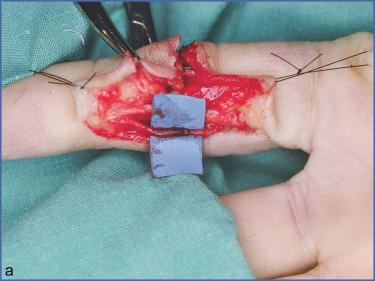 Fig. 8.2, Use of a Vein Graft.