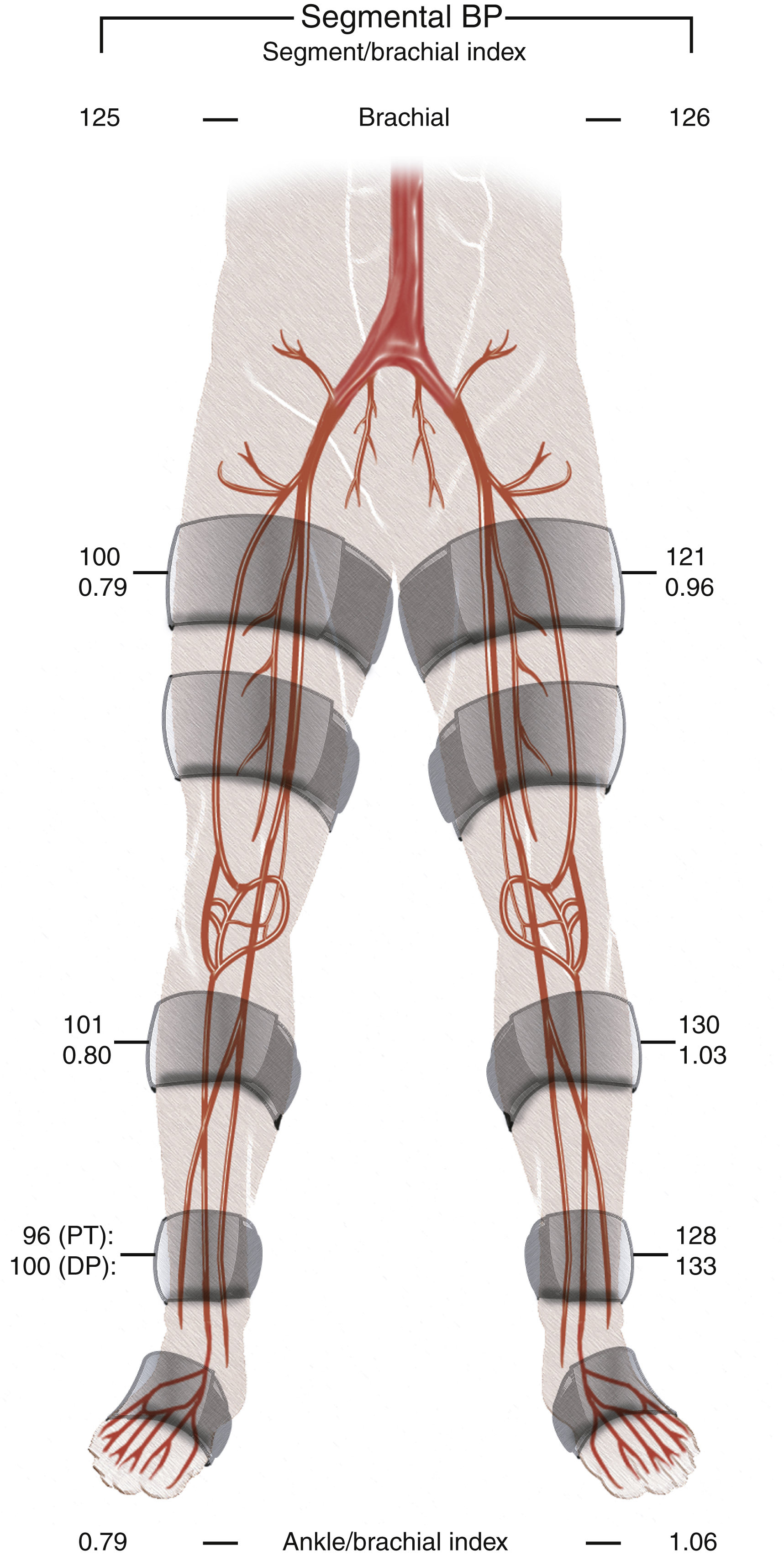 Fig. 13.1, Segmental blood pressures with measurements at high thigh, calf, and ankle levels in a patient with right thigh claudication. Note significant decrease in right thigh brachial index (0.79), demonstrating a likely right iliac–common femoral occlusive disease. Also note smaller but still abnormal decrease in the left thigh brachial index (asymptomatic side). No significant drop-off in level below thigh is noted. Segmental pressures are useful to delineate level(s) of occlusive disease. From Criqui MH, Aboyans V. Epidemiology of peripheral artery disease. Circulation Research. 2015:116(9):1509-1526.