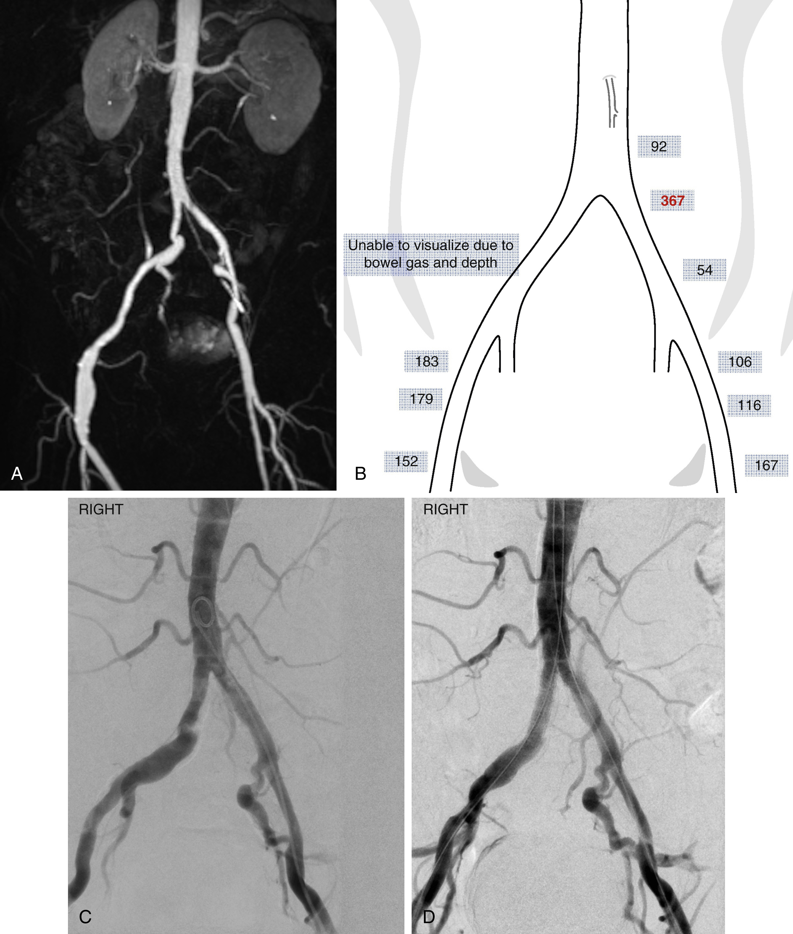 Fig. 13.2, Use of Doppler US to ascertain significance of borderline left common iliac artery stenosis identified on MR. (A) MRA demonstrating web-like stenosis in the left common iliac artery, of unclear significance. (B) Doppler US demonstrates turbulent, high-velocity flow (doubling of velocities in keeping with a moderate stenosis) at this point in the L CIA. (C) Angiogram demonstrating subtle L CIA stenosis. (D) Angiography following stenting of the lesion with a self-expanding bare metal stent demonstrates improved luminal caliber.