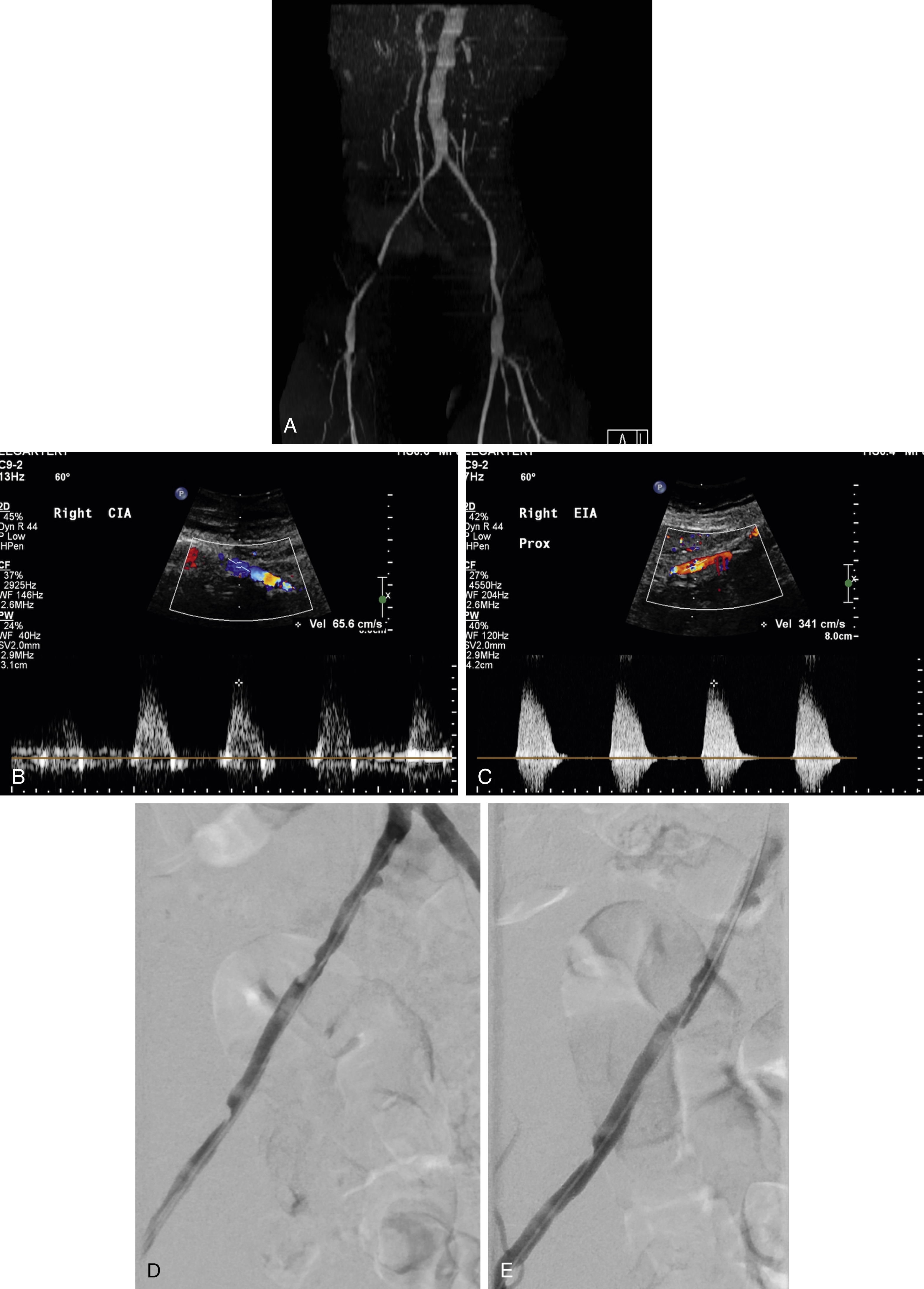 Fig. 13.3, Quiescent interval single shot (QISS) magnetic resonance angiography correlated with US and fluoroscopic angiography. (A) 3D Coronal maximum intensity projection image from QISS MRA demonstrating severe R EIA stenosis. (B) Doppler US of segment preceding the stenosis. (C) Doppler US of stenotic segment demonstrating turbulent flow and greater than fourfold increase in velocity, in keeping with a severe stenosis. (D) Visualization of R EIA lesion under fluoroscopic angiography. (E) Improved appearance of stenosis following self-expanding stent deployment and post-dilatation.