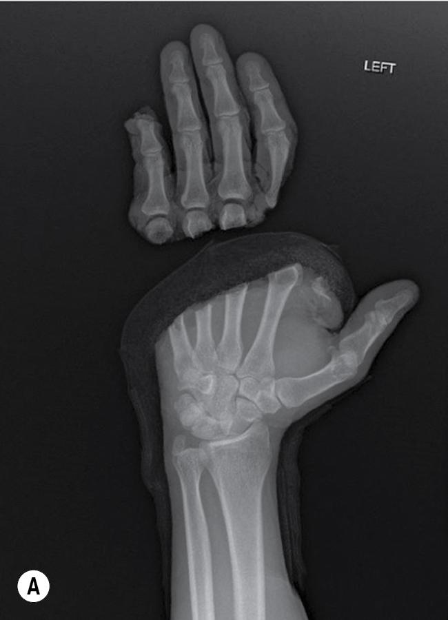 FIGURE 94.3, (A–C) PA, oblique, and lateral films of a multidigit amputation. PA , Posteroanterior.