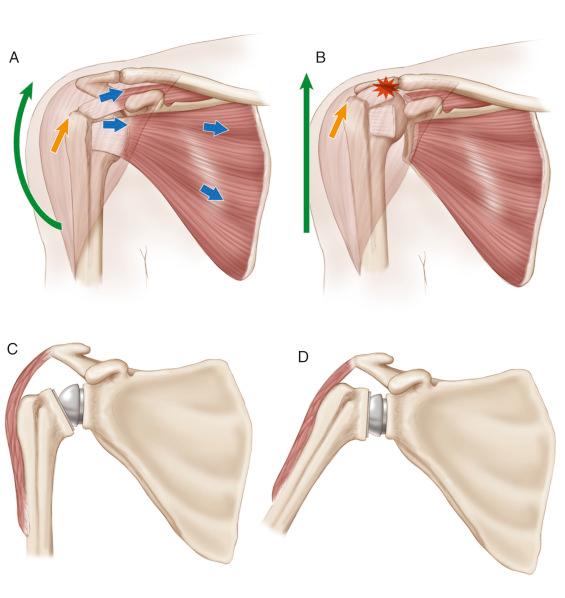 FIG. 39.1, In cases of an intact rotator cuff (A), the resultant force of the rotator cuff musculature ( blue arrows ) acts to center the humeral head in the glenoid and allow the force generated by the deltoid ( green arrow ) to rotate the arm with resulting force depicted by the gold arrow . In a deficient rotator cuff (B), there is no restraint to superior translation of the humeral head ( gold arrow ), so the deltoid contraction ( green arrow ) creates a shear force across the glenohumeral joint, leading to superior migration of the humeral head. A reverse prosthesis (C) creates a stable fulcrum that allows the deltoid to rotate the humerus around the fixed glenosphere even in the absence of the stabilizing effects of the rotator cuff (D). J Bone Joint Surg Am 2011;93(10):973–984.