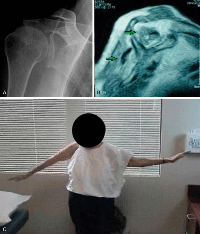 FIG. 39.2, (A–C) Pseudoparalysis of the right shoulder manifesting as shoulder shrug on attempted abduction. The green arrows indicate atrophy of the affected rotator cuff muscles, often seen in the setting of chronic massive tearing of the rotator cuff.