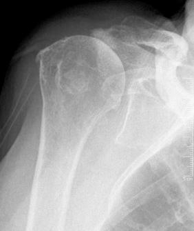 FIG. 39.3, Superior migration of humeral head with narrowing of the acromiohumeral distance and acetabulization of the acromion seen on plain radiographs in cuff tear arthropathy. Skeletal Radiol 2004;33(9):514–8.