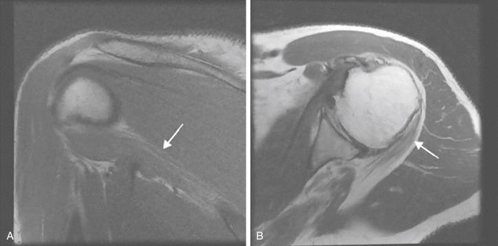 FIG. 39.4, (A,B) Significant fatty atrophy of the teres minor seen on magnetic resonance imaging ( white arrows ). Patients lacking a functional infraspinatus–teres minor motor unit may demonstrate lack of external rotation seen clinically as a Hornblower’s or external rotation lag sign. This patient population may benefit from latissimus dorsi transfer in addition to reverse shoulder arthroplasty to restore active external rotation. From Skeletal Radiol 2004;33:514–518.