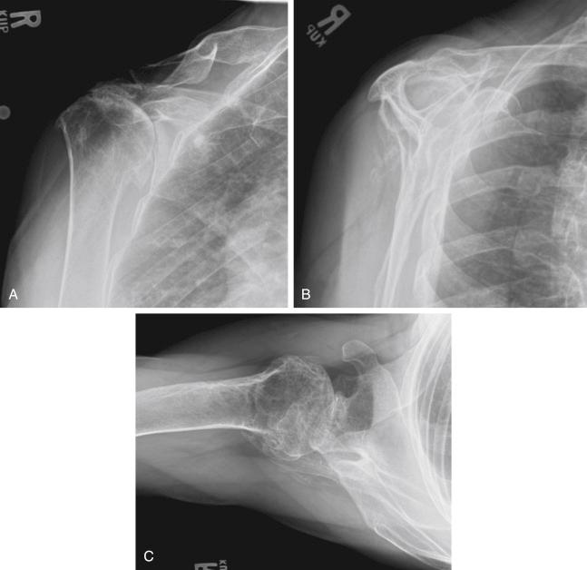 FIG. 40.1, Preoperative radiographs (A–C) demonstrate findings of rotator cuff arthropathy with superimposed glenohumeral osteoarthritis, including glenohumeral joint space narrowing, superior humeral head migration, and acromial acetabulization. Anteroposterior (A), scapular-Y (B), and axillary (C) views are shown.