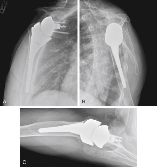 FIG. 40.2, Postoperative radiographs (A–C) demonstrate normal postoperative appearance of reverse total shoulder arthroplasty. Anteroposterior (A), scapular-Y (B), and axillary (C) views are shown.