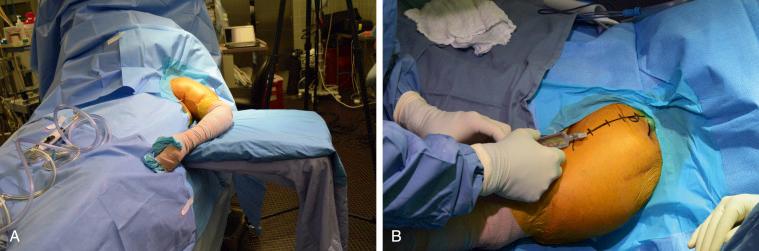 FIG. 40.3, Patient positioning (A) in beach chair position and skin marking of the deltopectoral incision (B) are shown.