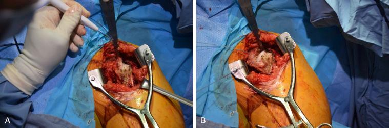 FIG. 40.4, Subscapularis takedown from the lesser tuberosity using needle-tip electrocautery is shown (A), and the subscapularis is tagged with high–tensile-strength suture for later repair (B).
