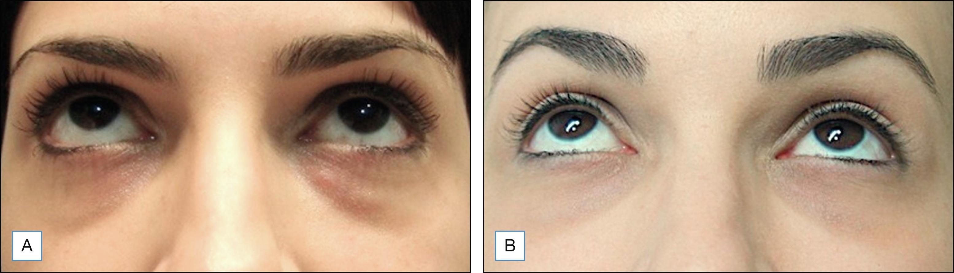 Fig. 38.2, (A) Patient after 6 months of hyaluronic acid filler for tear trough correction and (B) 15 days after 8 U hyaluronidase each side (4 U per lump).