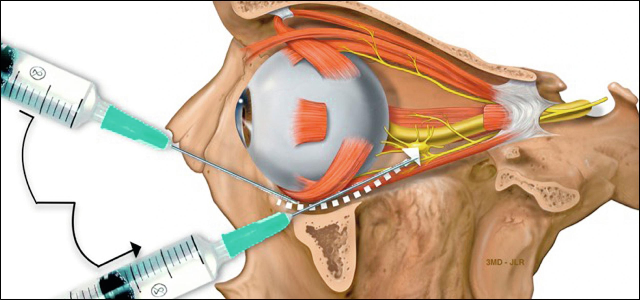 Fig. 38.3, How to perform retrobulbar injection of hyaluronidase if occlusion of ophthalmic artery of retinal artery is suspected.(Original image attribution goes to Patrick J. Lynch, http://commons.wikimedia.org/wiki/Category:Medical_illustrations_by_Patrick_Lynch .)