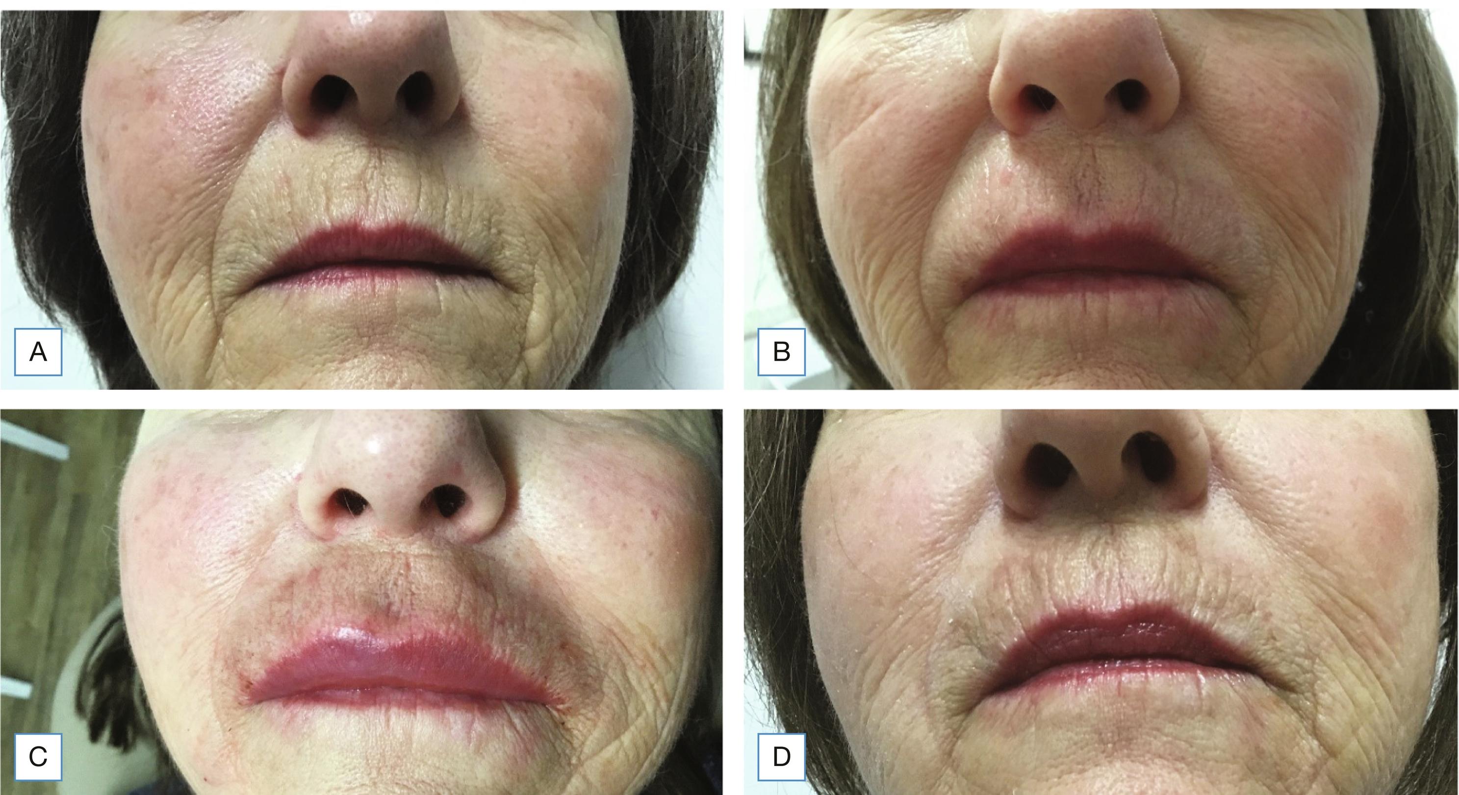 Fig. 38.4, (A) Before and (B) 3 months after 1 cc of hyaluronic acid filler to upper cutaneous vertical lip lines showing granuloma formation. Treated with 1 cc Hylenex, 0.5 cc 1% lidocaine, doxycycline 100 mg BID × 10 days, prednisone 40 mg × 5 days. (C) 4 months, worsening, treated with 2 cc Hylenex, 0.5 cc 1% lidocaine, 0.7 cc ILK 5 mg/cc, prednisone 40 mg × 3 days, 20 mg × 3 days, 10 mg × 3 days. (D) 4.5 months, granuloma resolved.