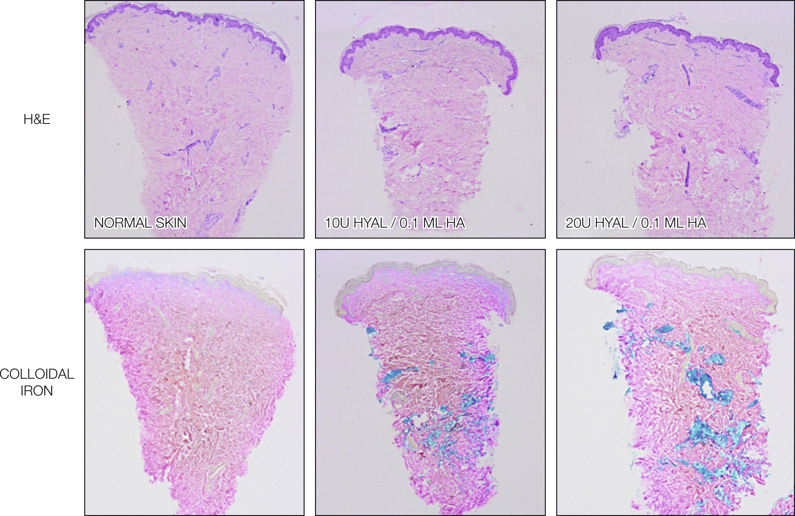 Fig. 38.5, Skin biopsy stained with colloidal iron to compare the amount of hyaluronic acid in normal skin and after 10 and 20 U of hyaluronidase showing no natural hyaluronic acid difference.