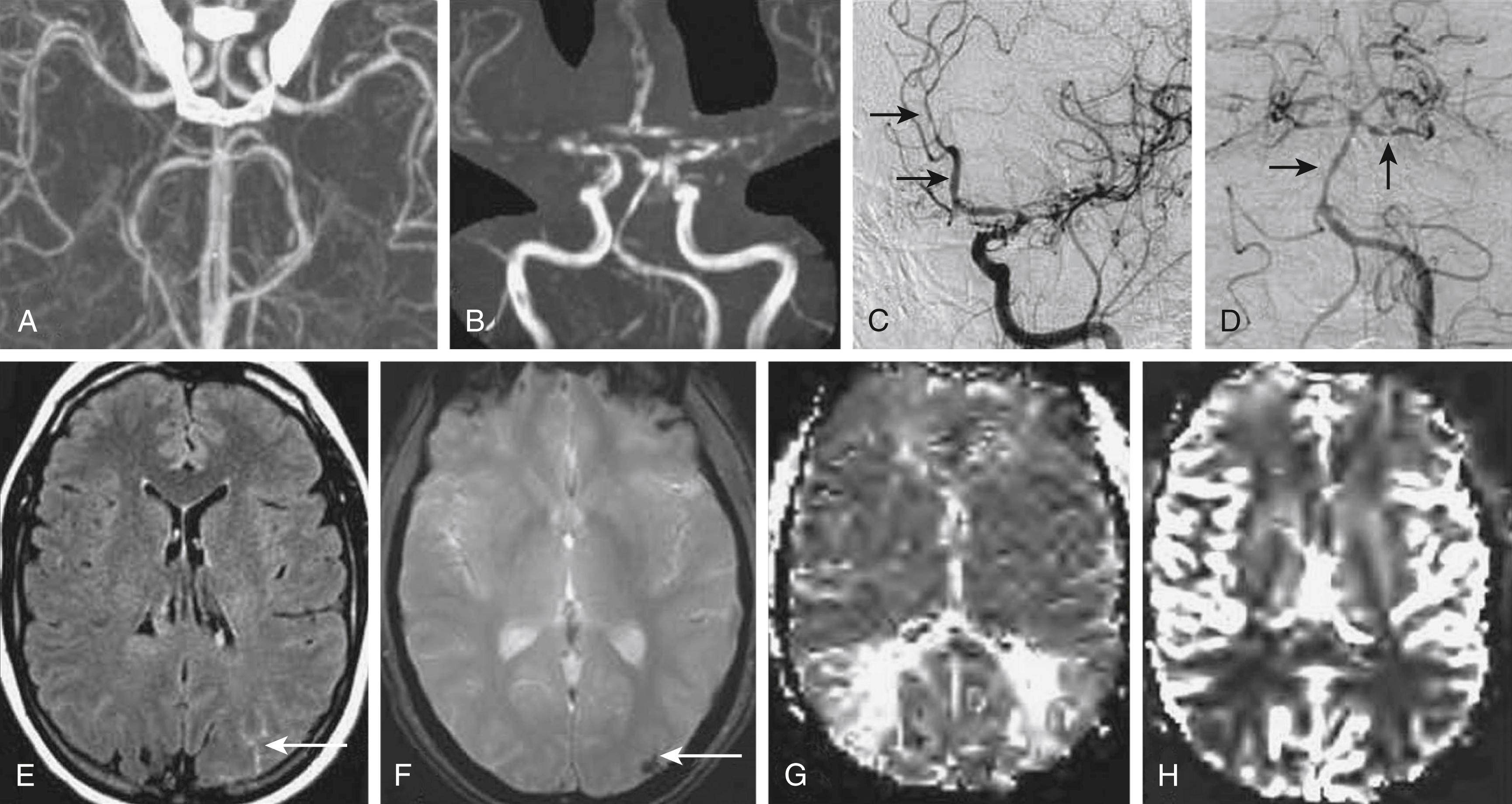 Fig. 37.1, Typical case of reversible cerebral vasoconstriction syndrome (RCVS). A 44-year-old woman with prior migraine and depression experienced a sudden, excruciating (thunderclap) headache while exercising. The headache did not resemble her prior migraines and resolved over 30 minutes. Over the next week, three more thunderclap headaches occurred. Blood pressure and neurologic findings were normal. CT angiogram (A), MR angiogram (B), and digital subtraction angiogram (C and D) show segmental narrowing and dilatation of multiple intracerebral arteries. Note the abnormal dilatation followed by abrupt narrowing of the anterior cerebral artery ( arrows, C), the basilar artery ( horizontal arrow, D), and the superior cerebellar artery ( vertical arrow, D). This “sausage on a string” appearance is characteristic of RCVS. Brain MRI showed sulcal hyperintensity in the left occipital lobe on axial fluid-attenuated inversion recovery (FLAIR) images ( arrow, E), and corresponding sulcal hypointensity on gradient-echo images ( arrow, F), consistent with cortical surface subarachnoid hemorrhage. Perfusion-weighted MRI showed abnormally increased mean transit time (G) and reduced cerebral blood flow (H) in the “watershed” regions of the bilateral middle and posterior cerebral arteries; fortunately these regions did not progress to infarction. Cerebrospinal fluid examination findings were normal. Results of extensive tests for vasculitis were negative. She was treated with nimodipine. Over the next 2 weeks, her headaches resolved, and follow-up brain imaging showed resolution of the subarachnoid blood and vascular abnormalities.