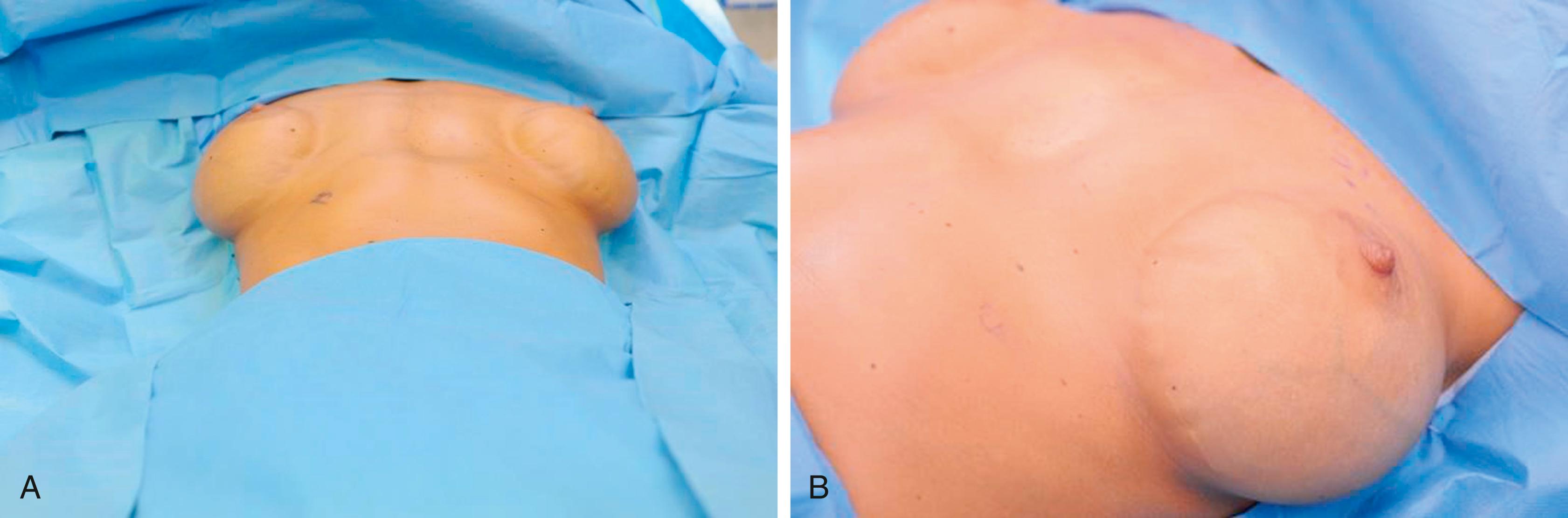 Fig. 12.3, (A, B) Lateral malposition is particularly common and prominent in prior transaxillary, non-endoscopic approach with saline implants and a lateral chest wall descent.