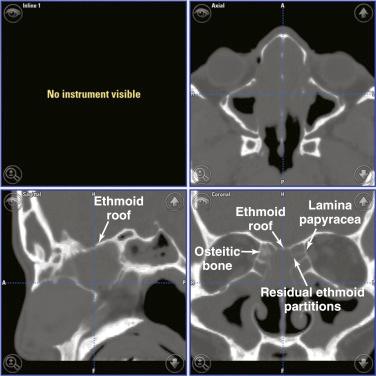 Fig. 14.1, Triplanar computed tomography images for a patient scheduled to undergo a revision completion sphenoethmoidectomy. Note the presence of numerous osteitic ethmoid partitions along the medial orbital wall and skull base.