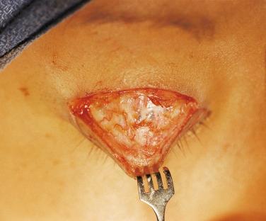 FIGURE 15-11, During the operation, previously placed levator-to-inferior subcutaneous sutures were an incidental finding.