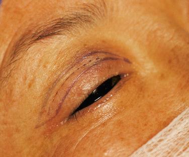 FIGURE 15-5, This patient had a higher than acceptable crease (dotted line); it was corrected by Asian blepharoplasty.