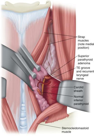 Fig. 63.1, The lateral approach.