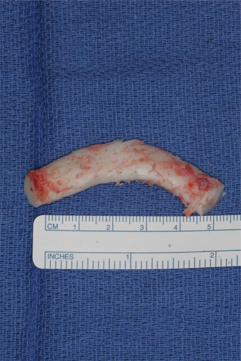 Fig. 34.1, Costal cartilage (6th rib) graft harvested from a 16-year-old female. Note the predominantly white color, denoting absence of calcification.