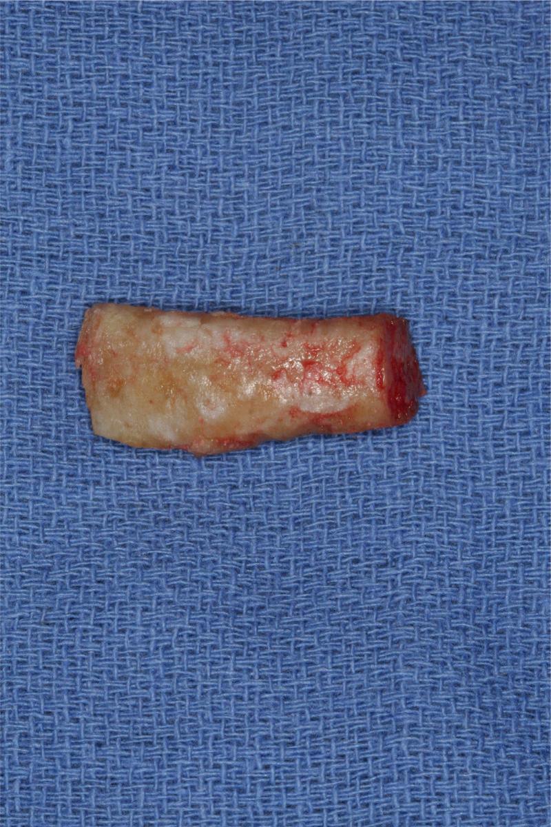 Fig. 34.3, Costal cartilage (7th rib) graft harvested from a 60-year-old male. Note the brown discoloration, which denotes moderate calcification.