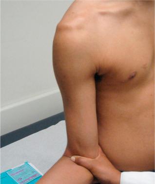 Fig. 43.1, Preoperative evaluation for recurrent shoulder instability should be comprehensive and include inspection, a careful neurovascular evaluation, assessment of passive and active range of motion, rotator cuff integrity and strength, and provocative tests specific for anterior shoulder instability. The involved shoulder is placed in abduction and external rotation, demonstrating symptomatic sulcus.